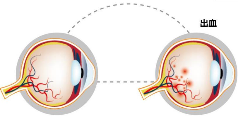 我的眼白发黄怎么回事啊,白眼球有红血丝是视网膜充血吗