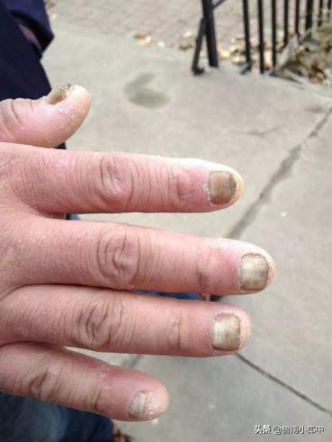 得了灰指甲一个传染俩靠谱吗,得了灰指甲一个传染两个