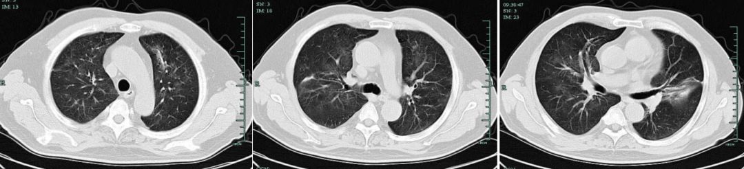 专家讲新冠二次感染的情况讲解,感染新冠专家怎么说