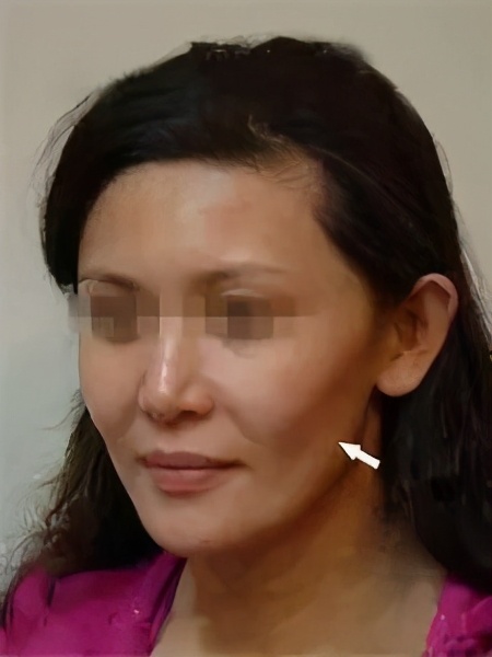 面部显老憔悴怎么办,显老显丧的面颊凹陷应该如何改善