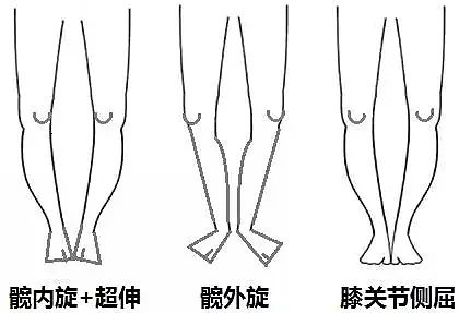 腿型有几种怎么矫正腿型,腿型大全