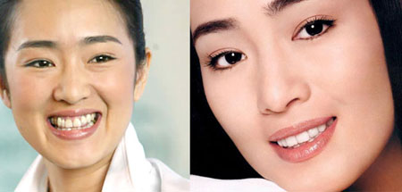 吴宣仪做牙齿前后对比,吴宣仪做整牙