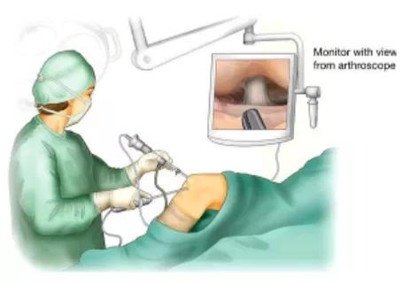 膝关节骨刺疼痛用艾灸有用吗,膝关节骨刺疼痛口服药