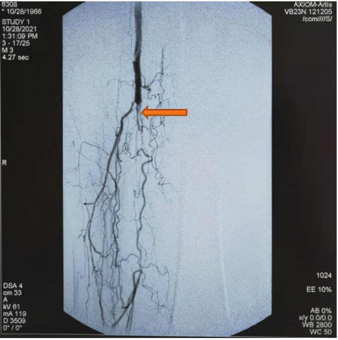 下肢动脉闭塞会导致脚疼吗,下肢动脉闭塞脚趾发麻
