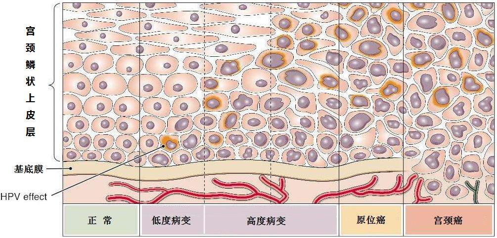 tct检查有异常是宫颈癌吗,tct检查什么样是得了宫颈癌