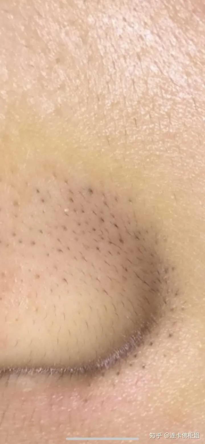 去除黑头只需一招简单有效不花钱,男生鼻子上黑头多去除最好的方法