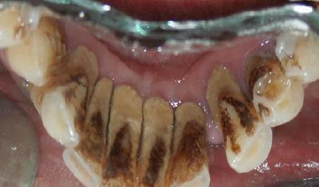 治疗它只要100多块，那为什么它却是口腔的“不治之症”？