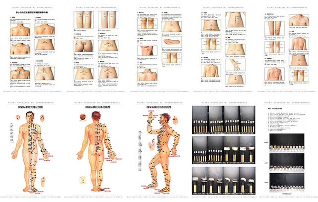 化脓灸怎样灸出疮来,化脓灸是不是把肉灸出疤