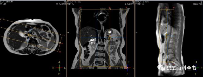 开展mrcp技术,mrcp检查操作流程