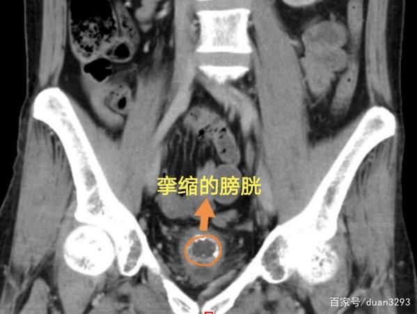 男子一天上三趟厕所查出癌症,49岁男子患结核