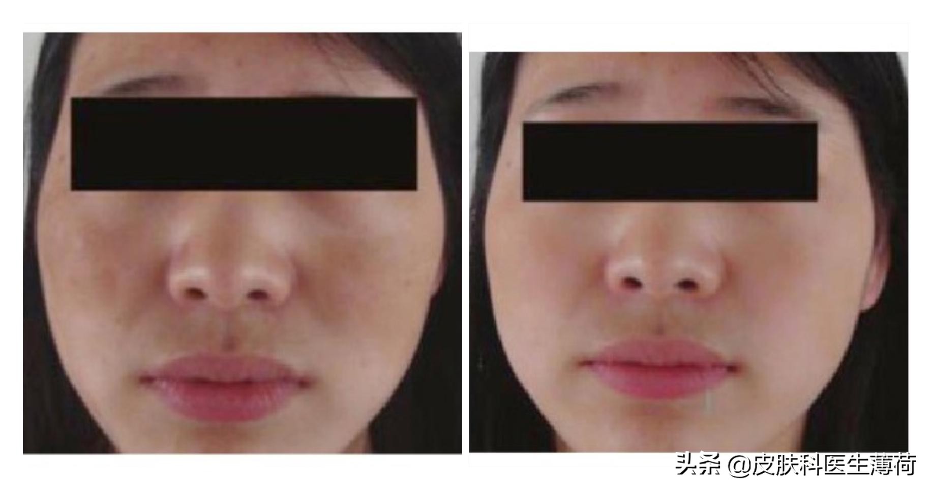 激光点阵祛痘坑收缩毛孔仪器,皮秒激光祛雀斑效果图