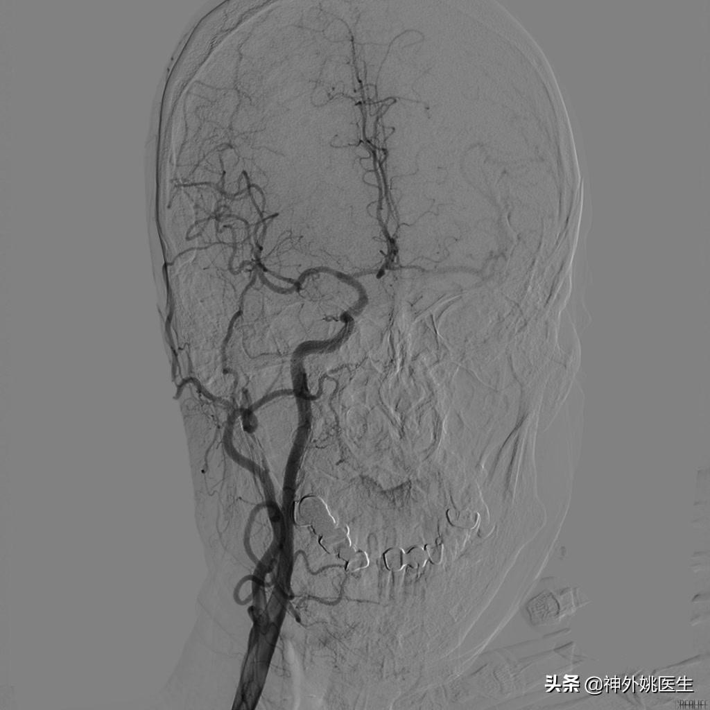 颈动脉狭窄的外科治疗