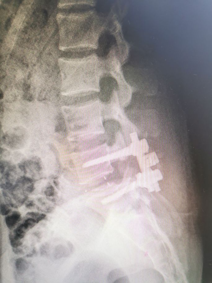 腰椎滑脱的治疗方法,腰椎滑脱手术医保多少钱