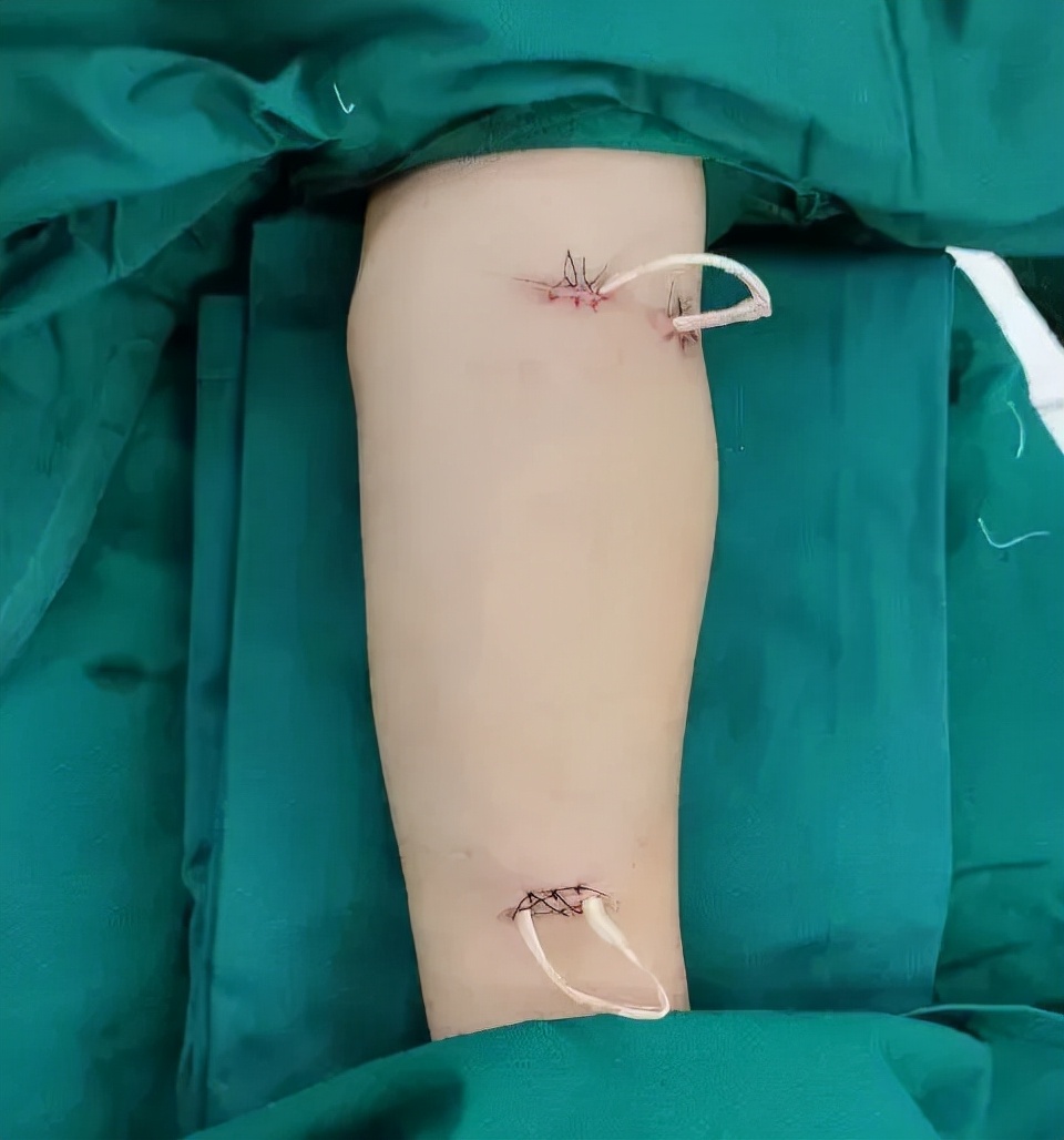 微创北京积水潭医院,肾内科血管造瘘