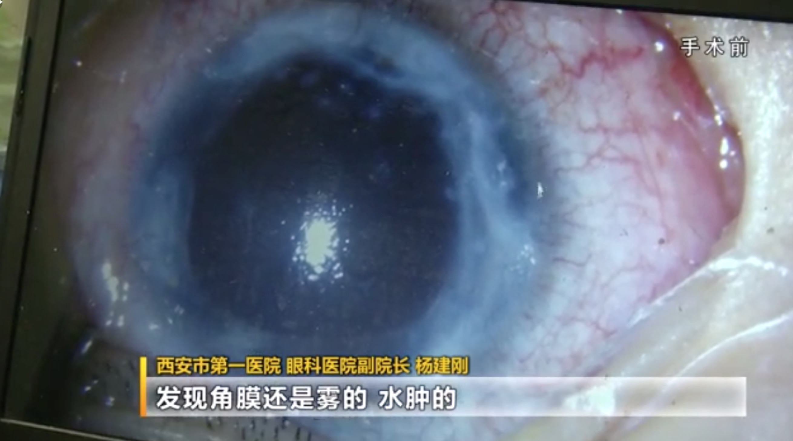 儿童摔倒眼睛短暂失明,2岁男童摔倒后续