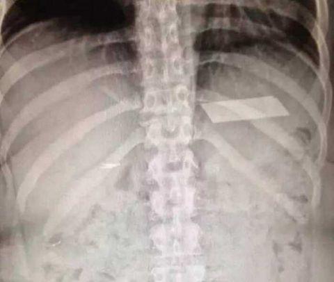 不作死就不会死,看看这些被人类搞进身体里的异物