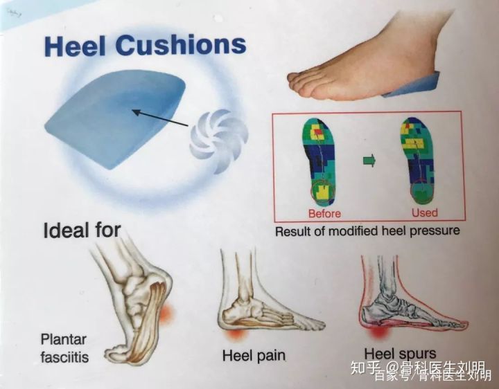 在家自己治疗足跟痛，你能行