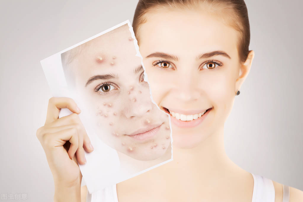 长青春痘的原因和治疗方法,长青春痘的原因和改善方法