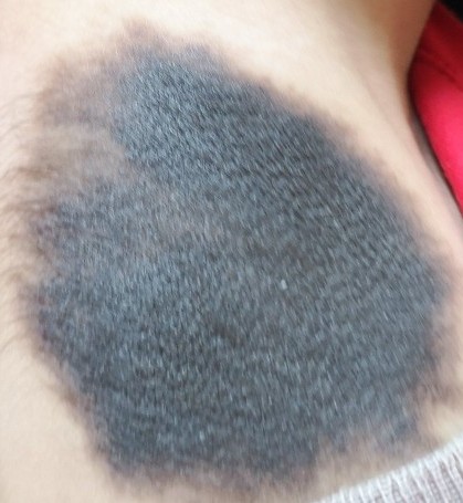 黑毛胎记科普,长满胎记的人