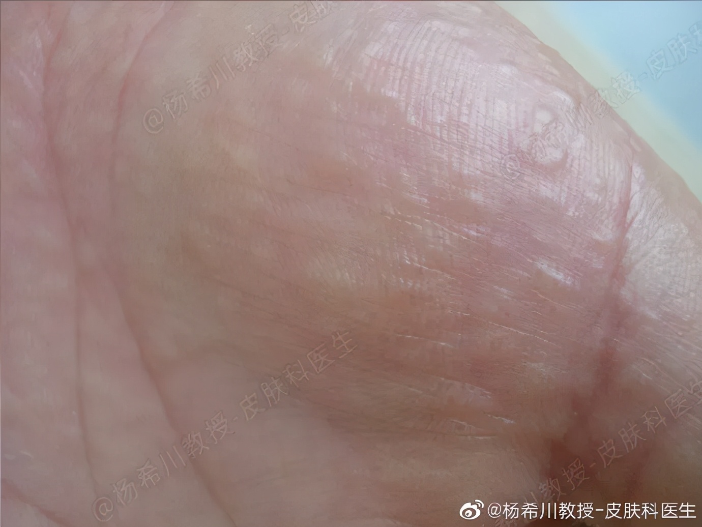 手上长汗疱疹痒在家怎么处理,手上出的汗疱疹水泡敢刺破吗