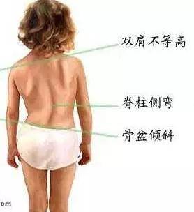 改善跷二郎腿的骨盆倾斜,骨盆倾斜可以反向跷二郎腿吗