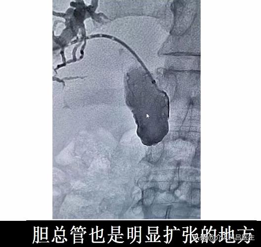 肿瘤导致黄疸,肝脏肿瘤压迫胆管应怎样治疗