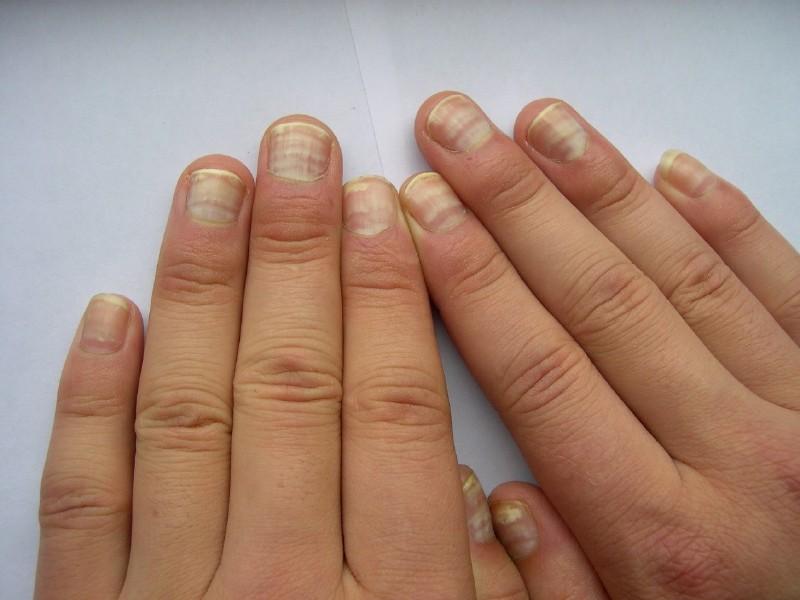 指甲问题对应身体哪里有问题,指甲的各种病变及解决办法