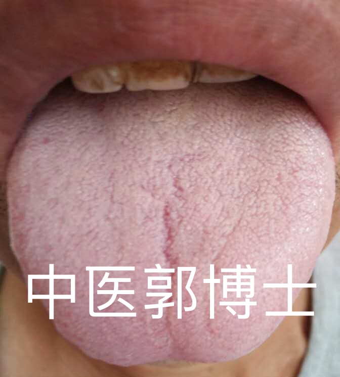 口干舌燥盗汗可以吃六味地黄丸吗,盗汗吃六味地黄丸还是知柏地黄丸