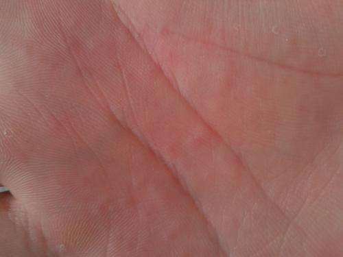 麻疹成因,荨麻疹形成的各种原因具体介绍