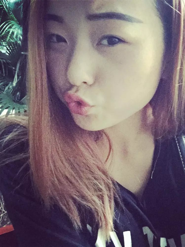 肋骨隆鼻最快的恢复方法,肋骨隆鼻即刻效果