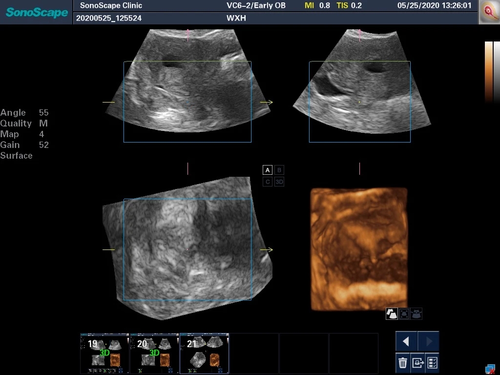 轻微宫腔粘连手术成功案例,轻度宫腔粘连分离术是大手术吗