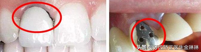 烤瓷牙不密合怎么办,烤瓷牙边缘不密合了怎么处理