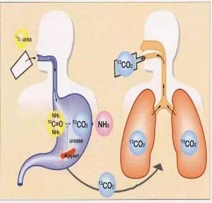 呼气试验结果越大，幽门螺旋杆菌感染就越重？在线医生请别乱说