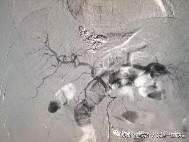 栓塞加消融能根治早期肝癌吗,西安肝癌介入治疗