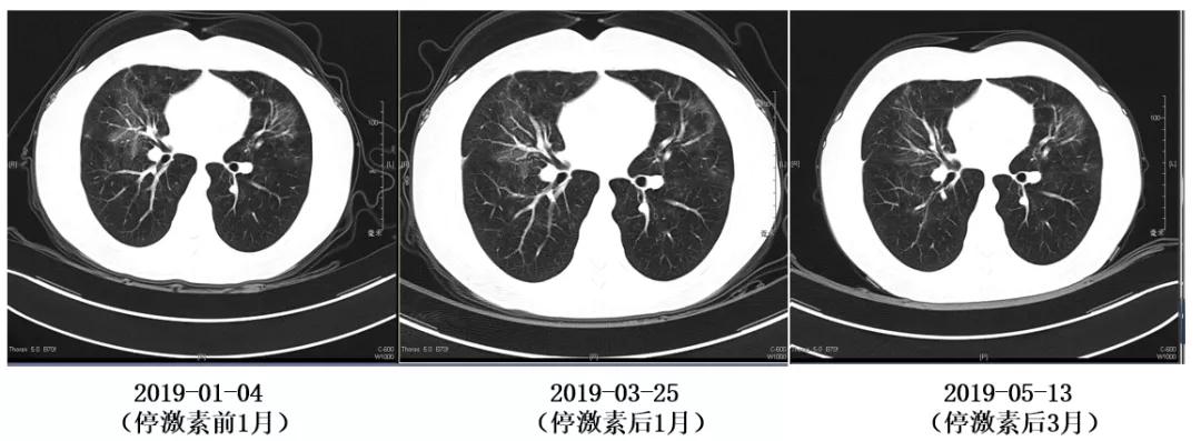机化性肺炎必须病理确诊吗,机化性肺炎好转的征兆