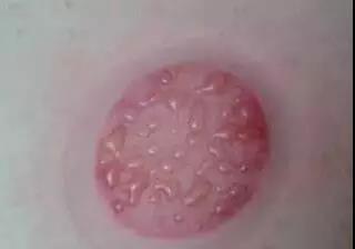 拔罐后为啥有的罐印有的深有的浅,拔罐对人是有好处还是有坏处