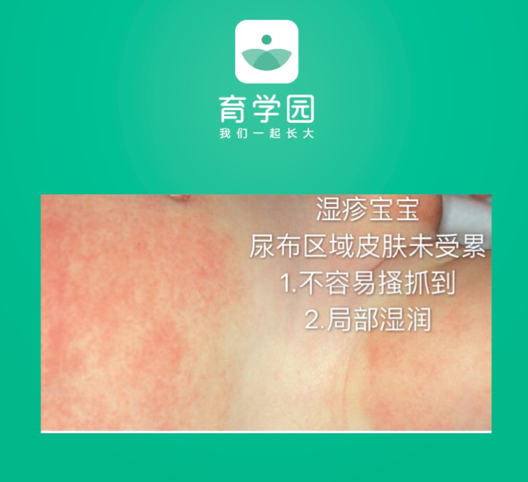 宝宝皮肤发红疹怎么办,宝宝皮肤发红粗糙还痒怎么回事