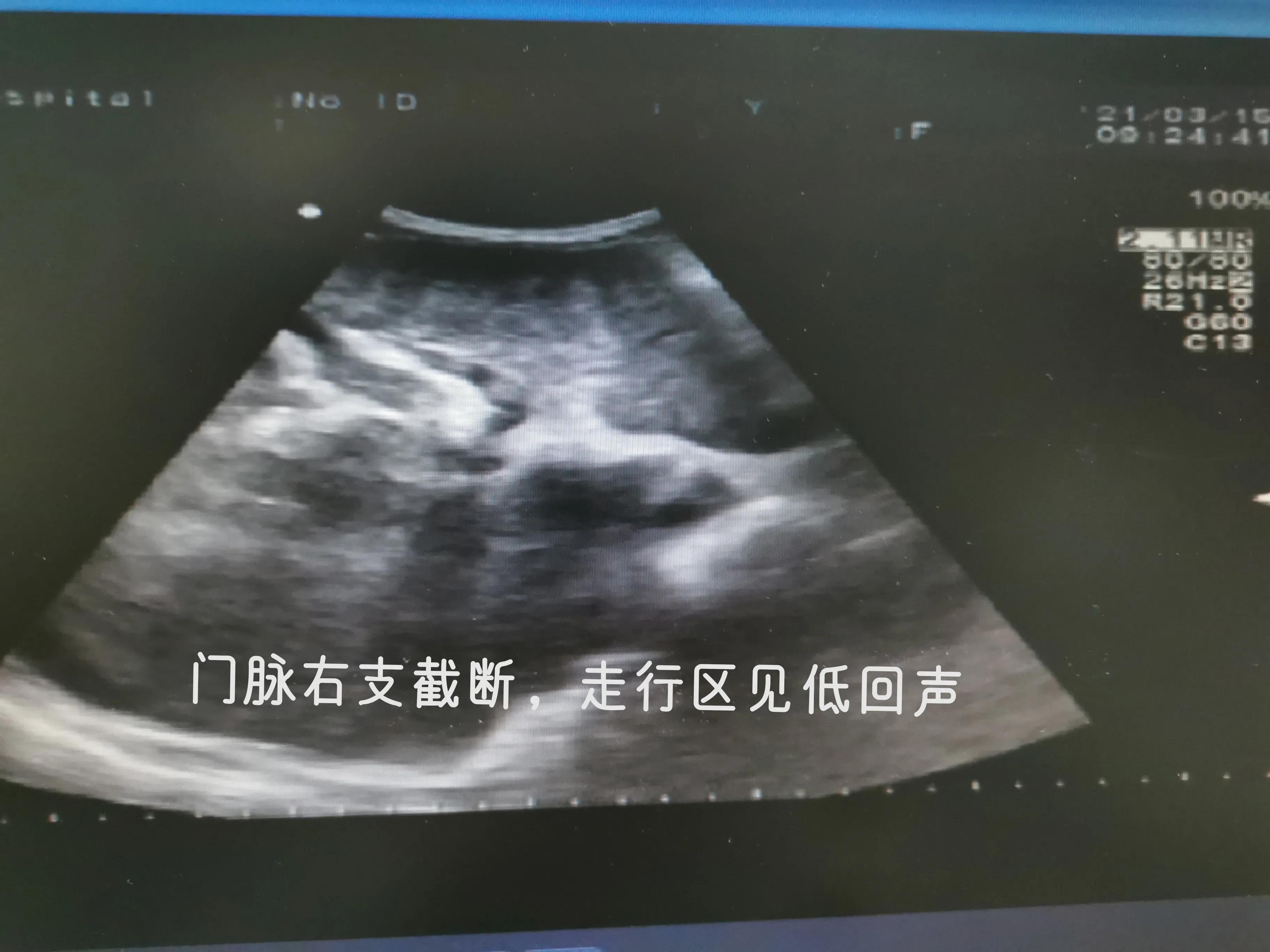 乙肝肝硬化和丙肝肝硬化的区别,乙肝肝硬化肝部占位是肝癌吗