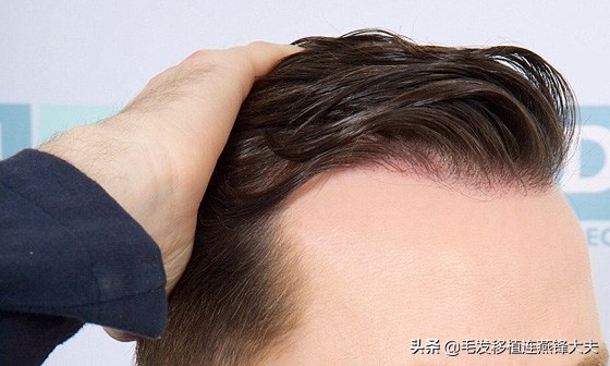 22岁得了脂溢性脱发,22岁脂溢性脱发还有救吗