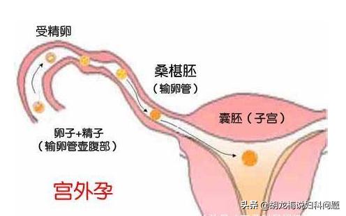怀孕初期1-7天能查出是否宫外孕,怀孕了怎么发现宫外孕有生命危险