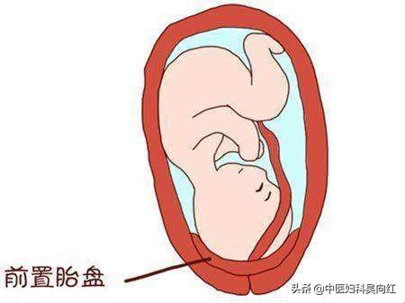 怀孕红血丝是什么原因,怀孕红点点是怎么回事