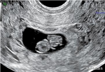 一分钟看懂孕期b超图,孕期32周照b超宝宝头大怎么办