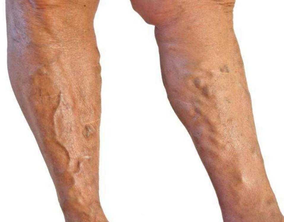 缓解静脉曲张的运动方法3种,缓解腿部静脉曲张最好的药