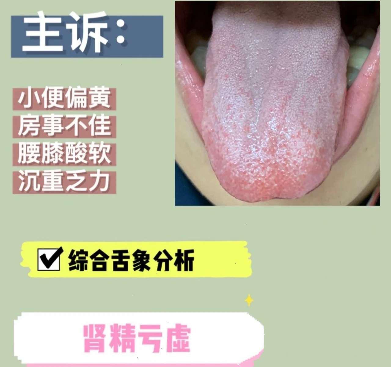 肾阳虚腰痛与肾阴虚腰痛的区别,男人腰疼是肾阴虚需要吃什么药