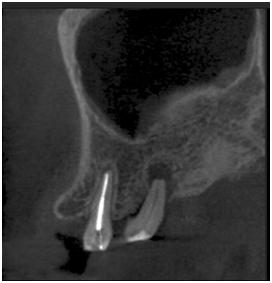 你们做根管治疗花了多少钱,根管治疗做了真的有用吗