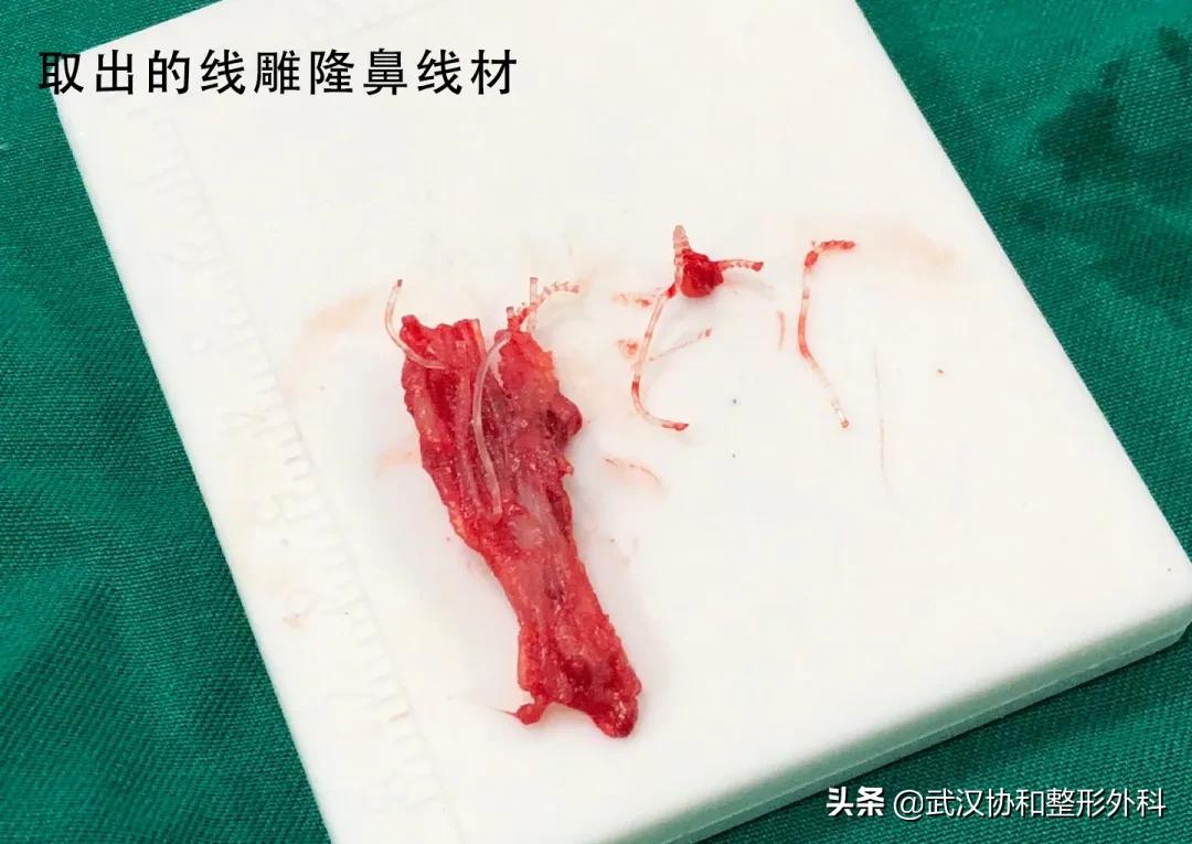 线雕隆鼻的副作用和危害,线雕隆鼻费用一般多少钱