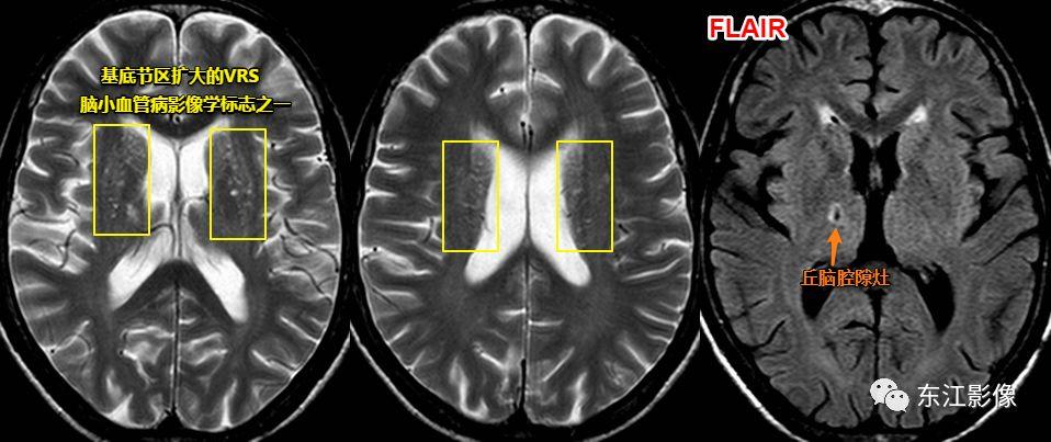 头颅mri扫描影像哪里找,头颅影像mra详细解说