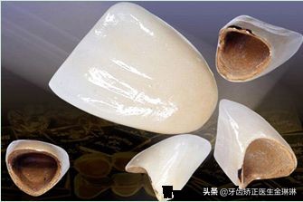 钴铬烤瓷牙和纯钛烤瓷牙的优劣,烤瓷牙真假怎么辨别