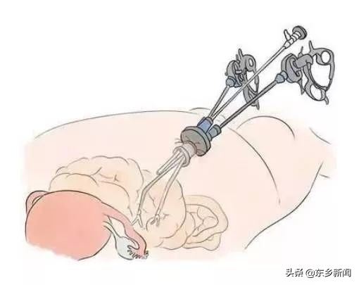 腹腔镜手术切除巨大卵巢囊肿,卵巢囊肿腹腔镜手术单孔