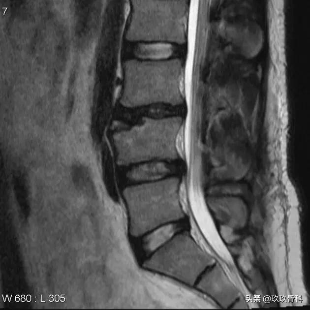 病例实讲|你是否也将其误诊为椎体骨折